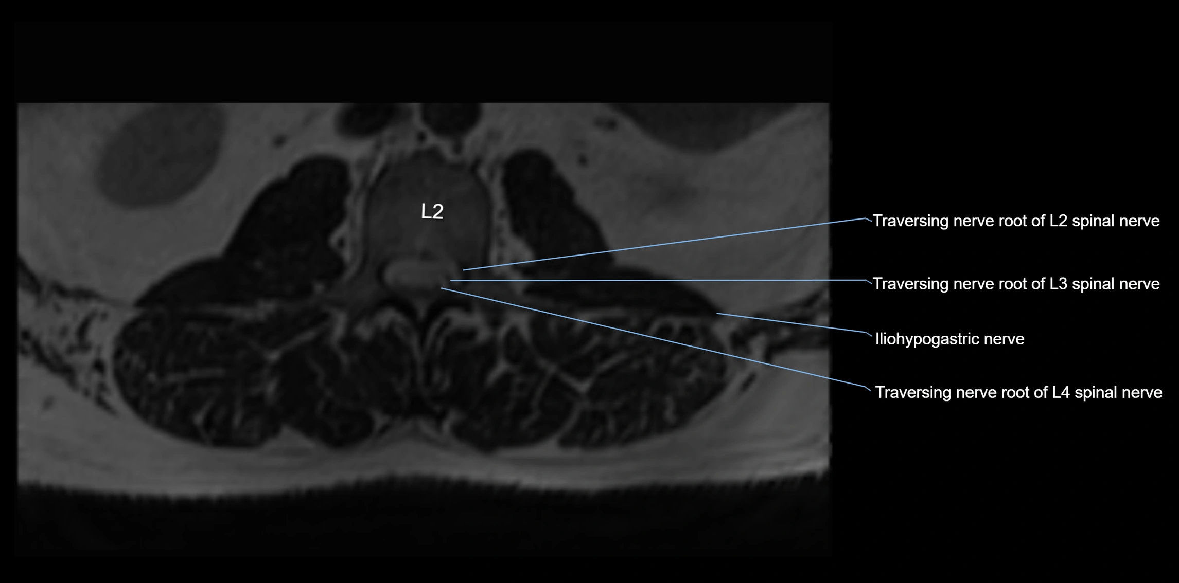 MR lumbosacral plexus axial cross sectional anatomy 3T  radiology  image-img-1008001-00001.webp